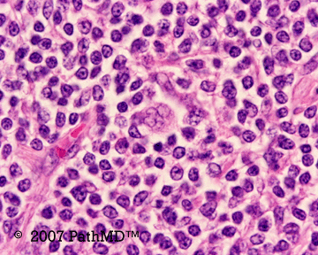 Hematopathology - Part 7, Case #7