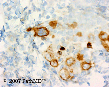 Hematopathology - Part 7, Case #7