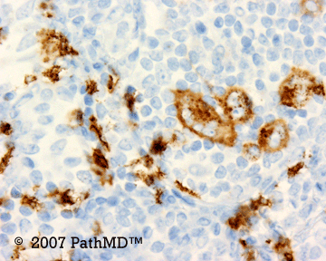 Hematopathology - Part 7, Case #7