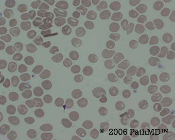 Peripheral Blood Part 1, Case #2