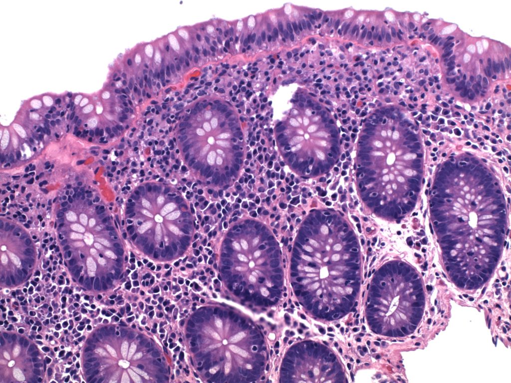 Gastrointestinal Pathology - Part 5, Question #1