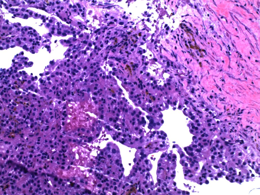 Renal Cell Carcinoma - H&E