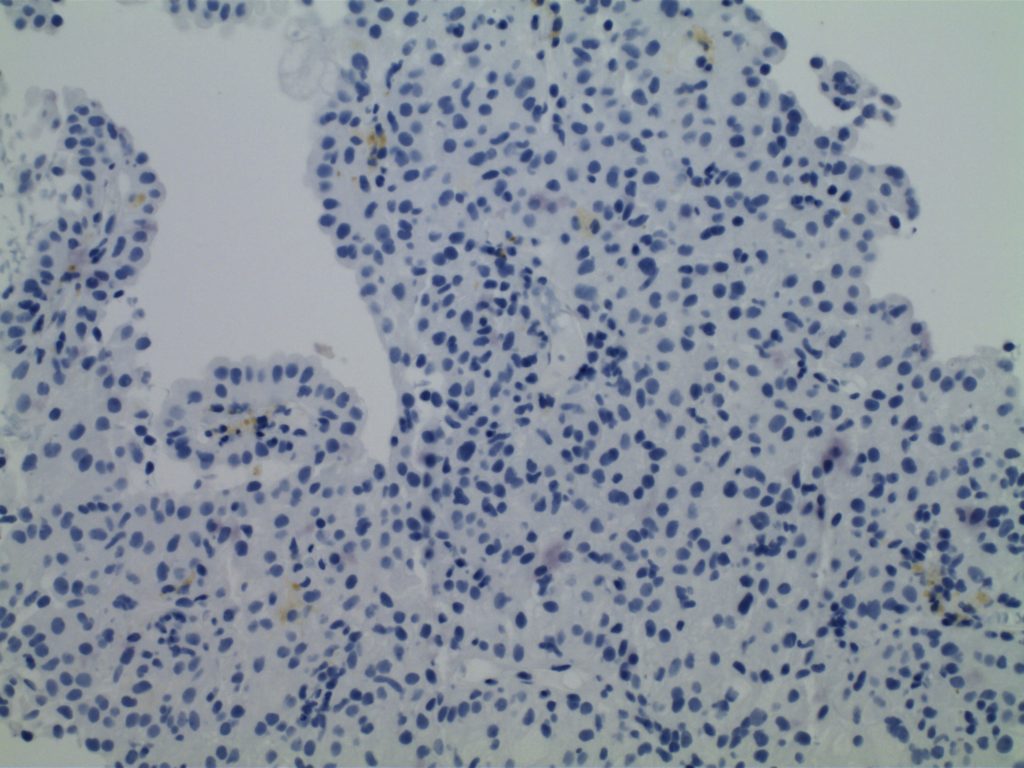Renal Cell Carcinoma - CK7