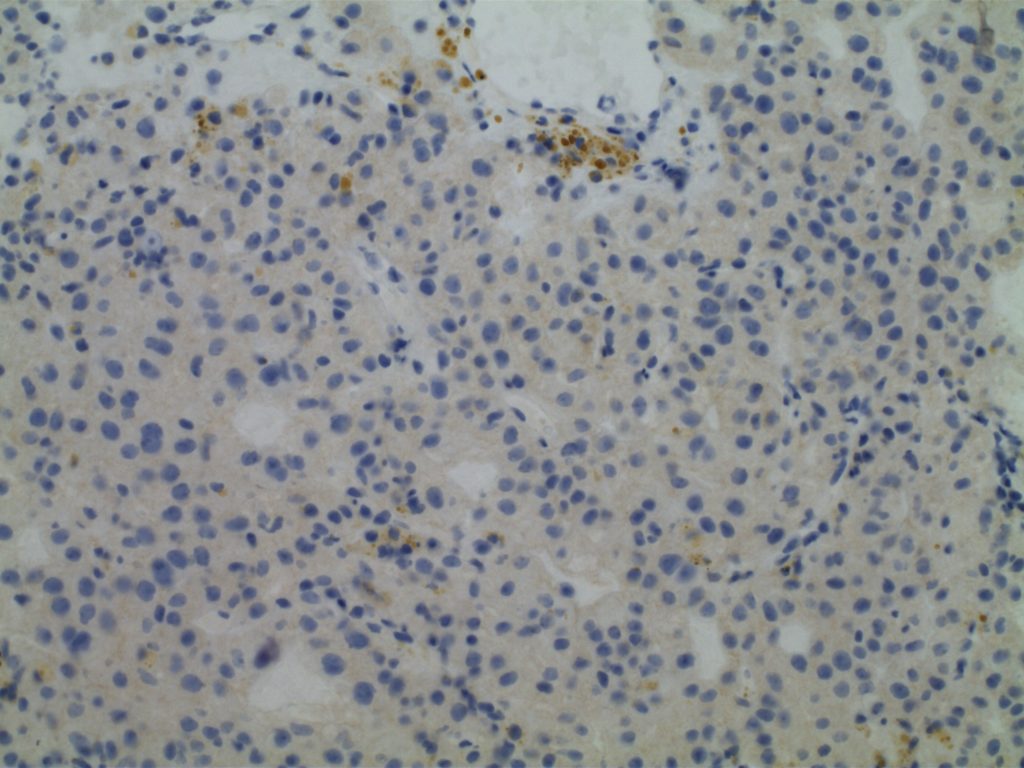 Renal Cell Carcinoma - HepPar-1