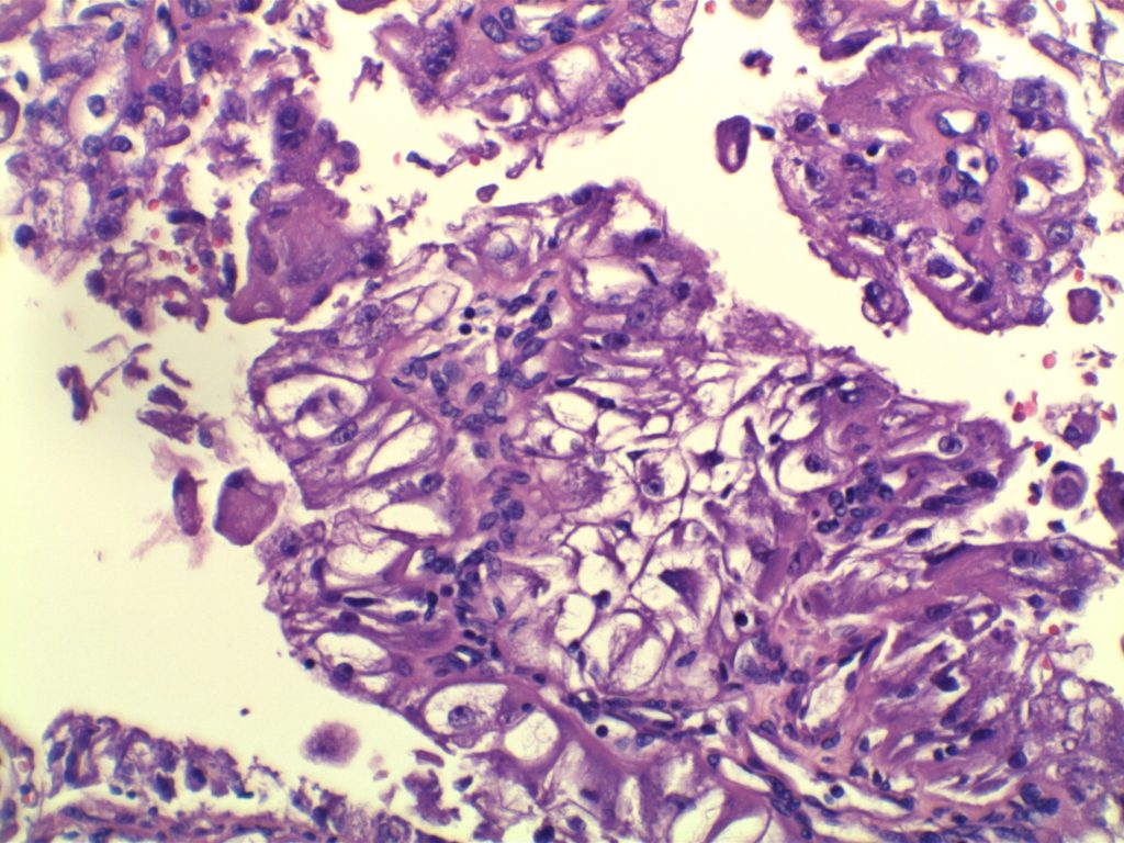 Xp11.2 Renal Cell Carcinoma