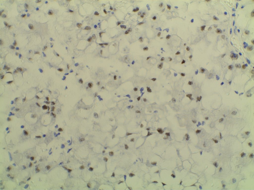 TFE3 - Xp11.2 Renal Cell Carcinoma