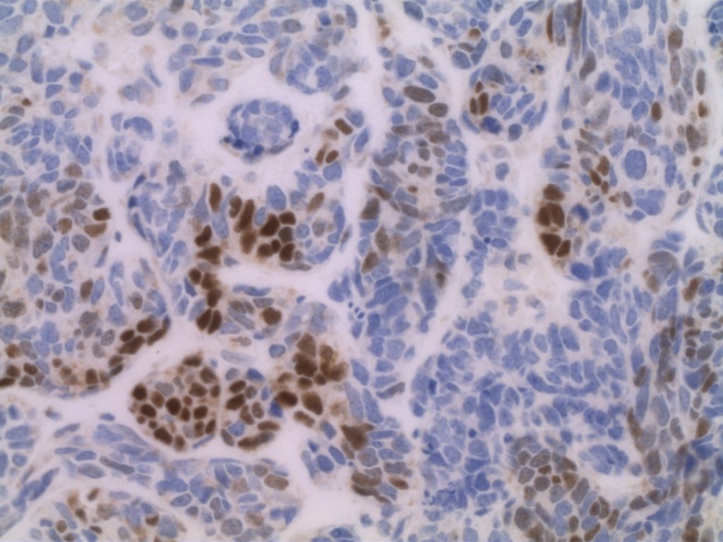 GATA-3 Bladder Small Cell Carcinoma