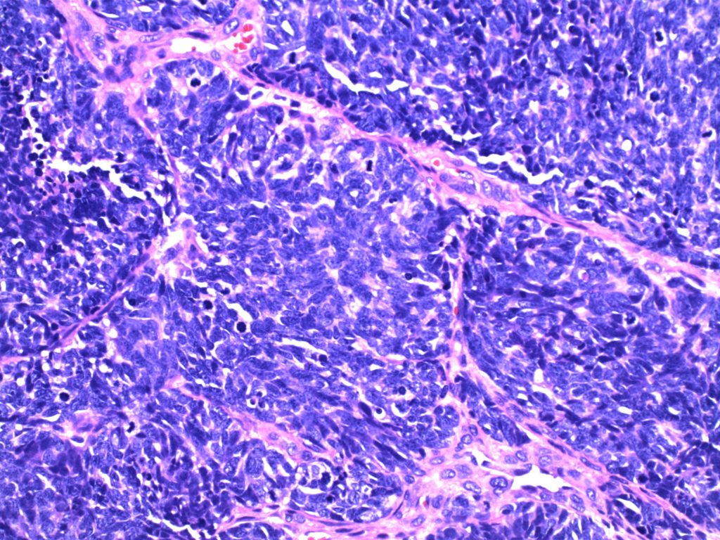 Bladder Small Cell Carcinoma