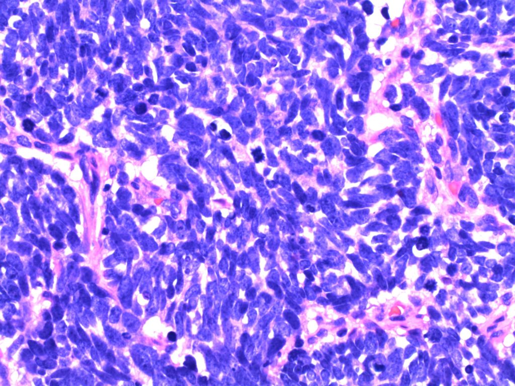 Bladder - Small Cell Carcinoma