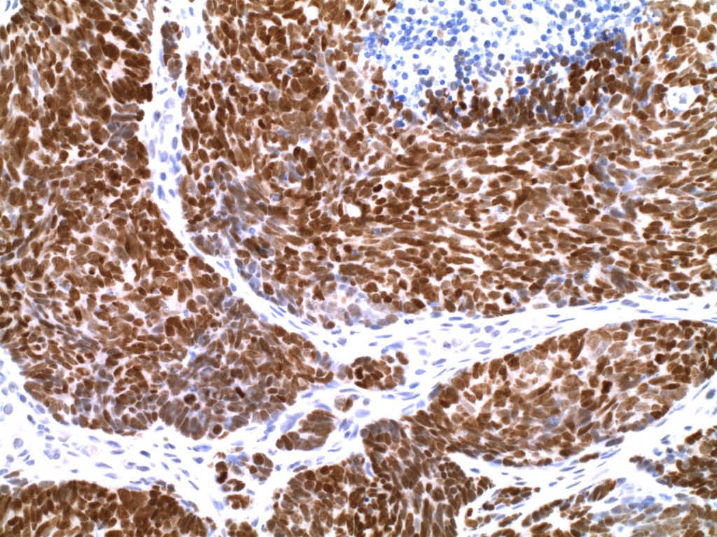 TTF-1-Bladder Small Cell Carcinoma