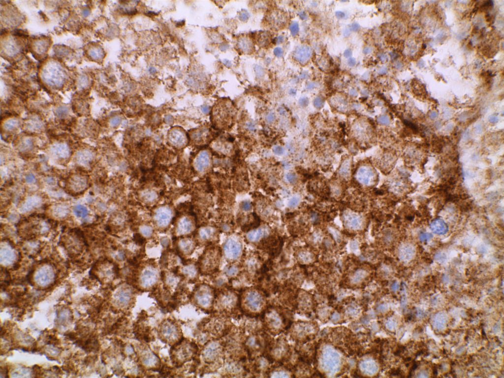 DLBCL Anaplastic Variant - CD20