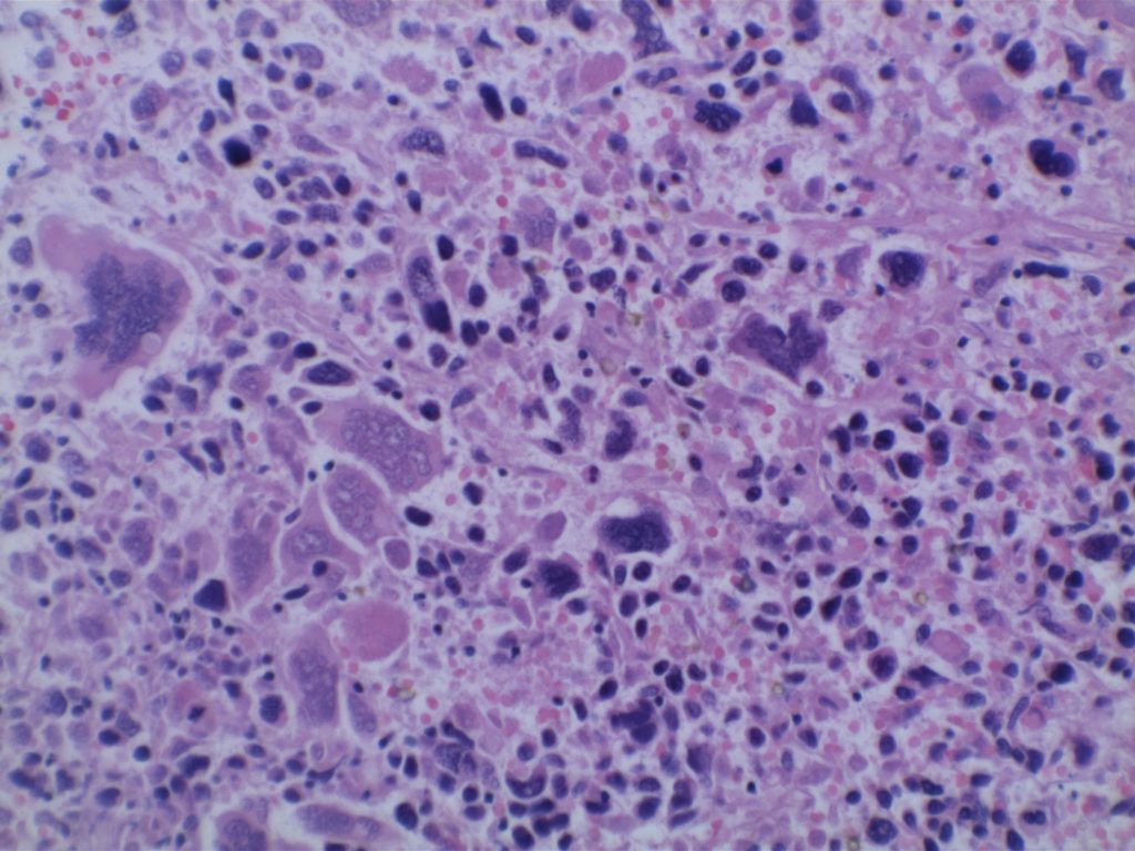 DLBCL Anaplastic Variant