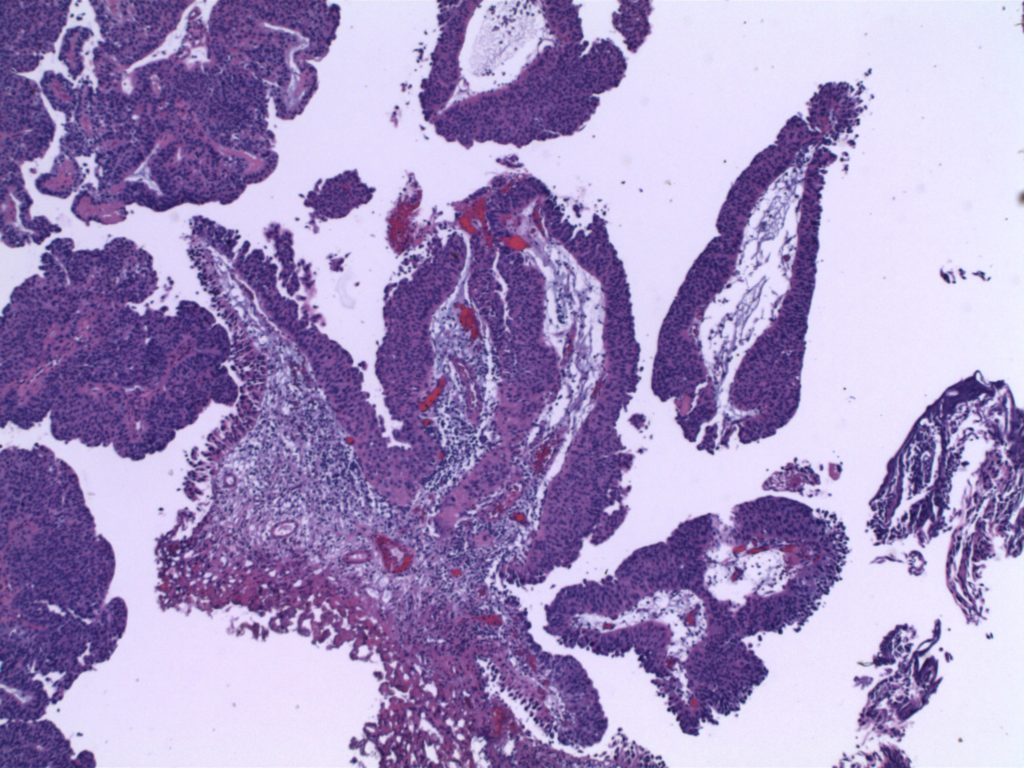 Bladder Tumor-High-Grade Papillary Urothelial Carcinoma