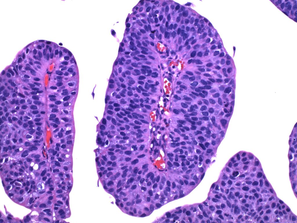 Bladder Tumor-High-Grade Papillary Urothelial Carcinoma