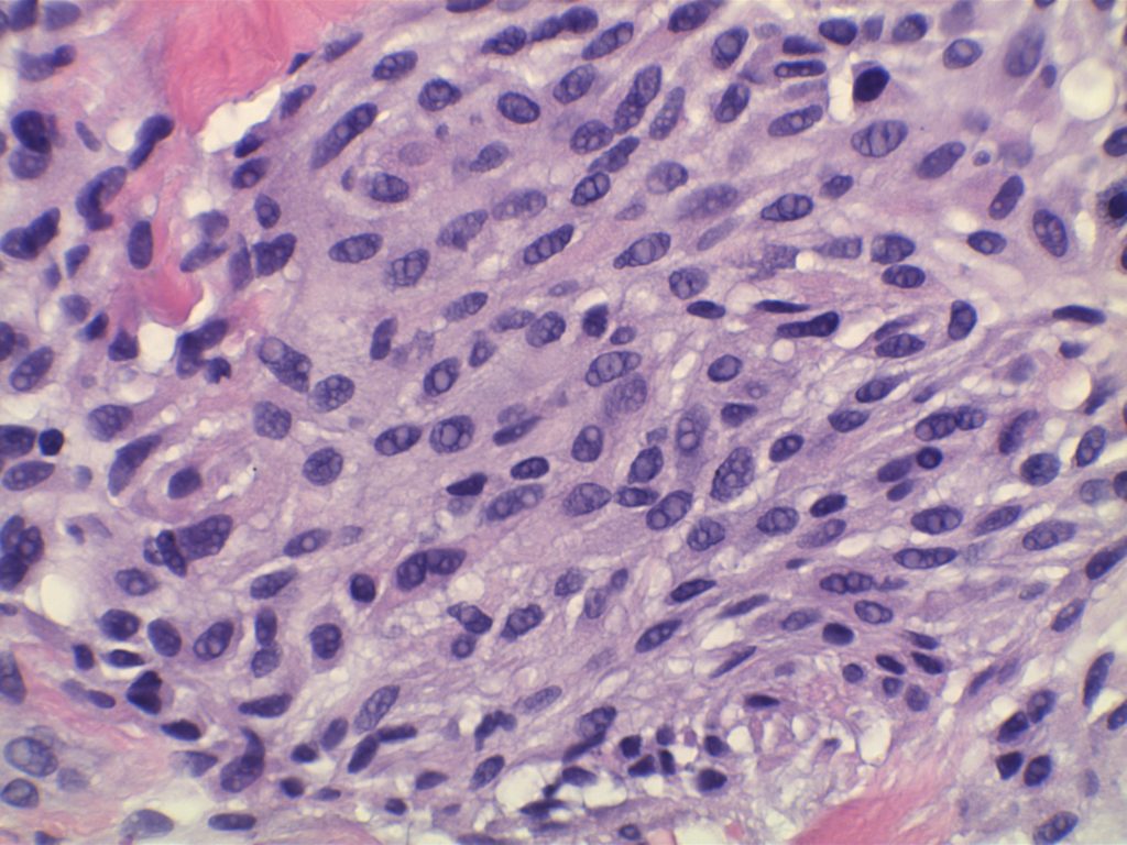Myofibroblastoma of breast